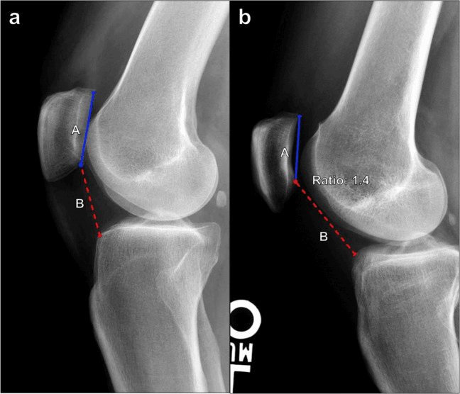 Lateral knee radiographs annotated for Caton Deschamps patellar height index