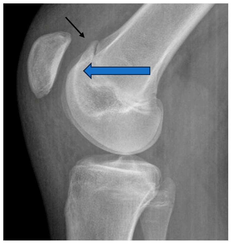 Lateral adolescent knee radiograph annotated with crossing sign and supratrochlear spur