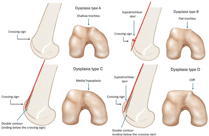 Dejour classification diagrams of trochlear dysplasia types A through D