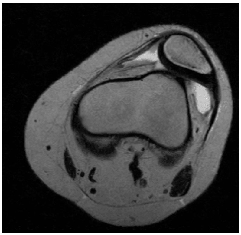 Axial MRI of an eight-year-old knee showing habitual patellar dislocation and dysplasia