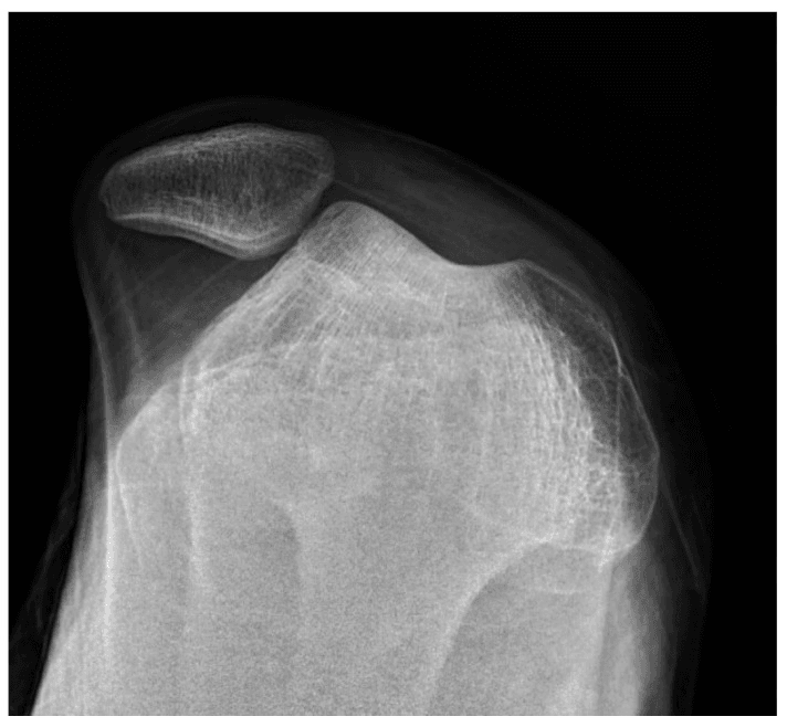 Axial knee radiograph showing the patella dislocated out of the trochlear groove in an adolescent