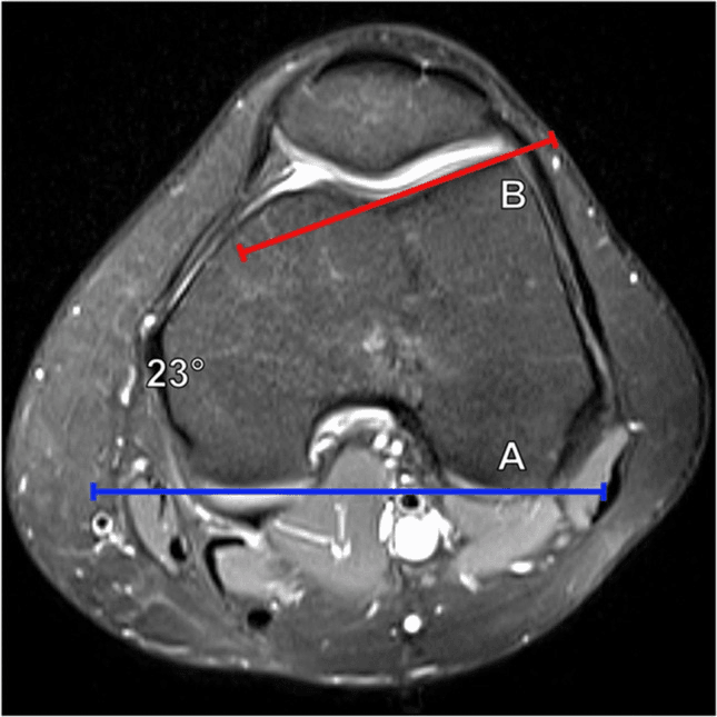 Axial knee MRI annotated for lateral trochlear inclination