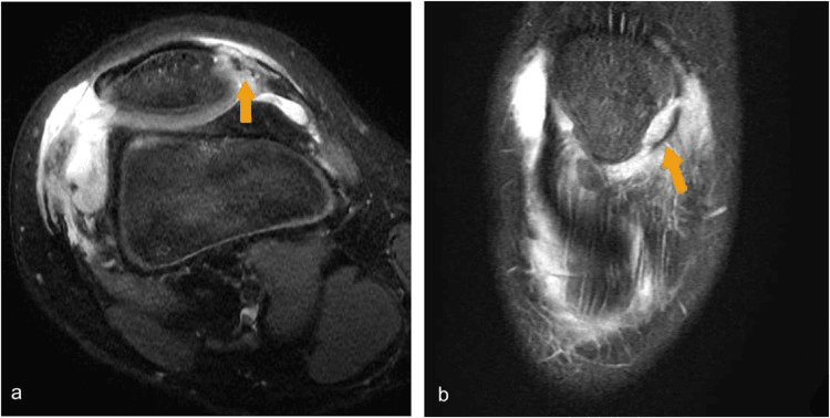 Knee MRI showing patellar osteochondral fracture and retinacular tear