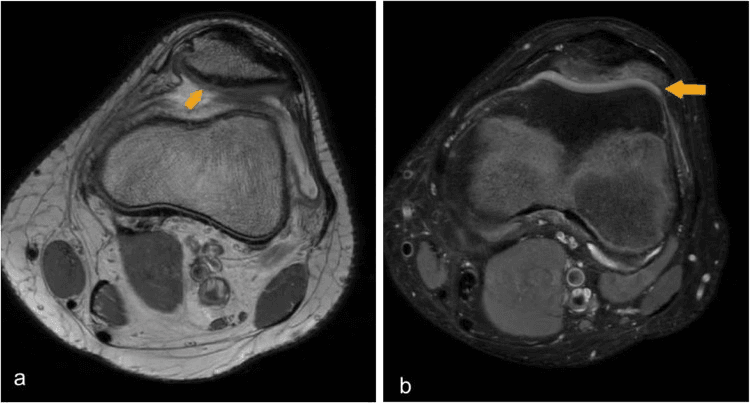 Axial knee MRI showing patellar cartilage injury after dislocation