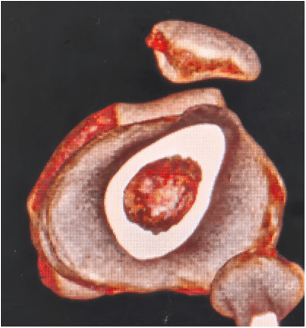 Three-dimensional CT showing lateral patellar subluxation