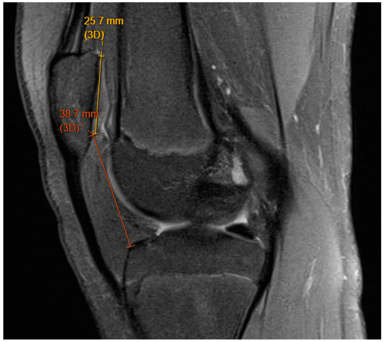 Sagittal paediatric knee MRI annotated for Caton Deschamps index