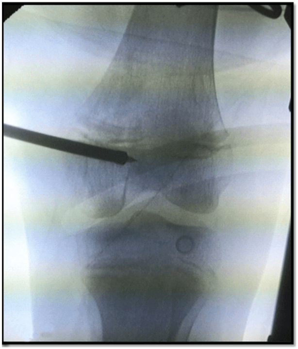 Fluoroscopic image of physeal-sparing femoral tunnel reaming for MPFL reconstruction