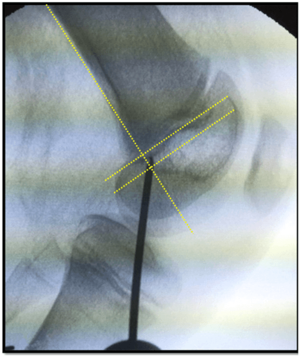 Lateral knee fluoroscopy with reference lines targeting the femoral MPFL fixation point