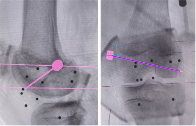 Fluoroscopic images measuring Schottle point relative to distal femoral physis