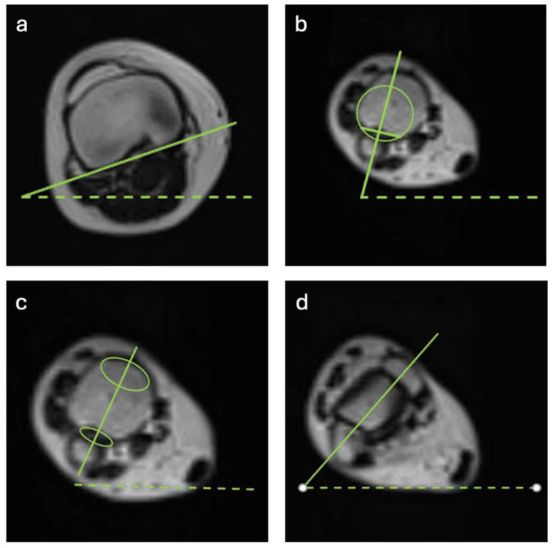 Four axial images showing different axes used for tibial torsion measurement