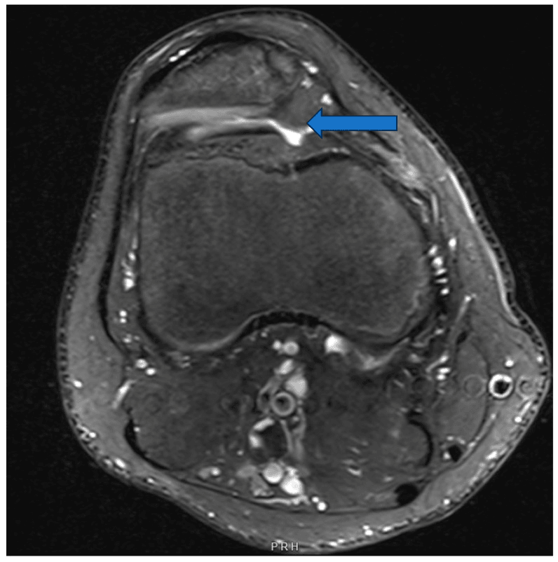 Axial adolescent knee MRI showing absent trochlear groove and patellar subluxation