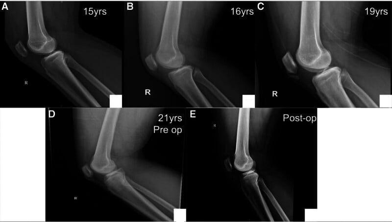 Serial lateral knee radiographs showing progression of an inferior-patellar-pole ossicle and postoperative appearance.