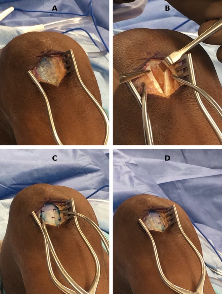 Four-panel operative sequence of open patellar tendon debridement, inferior-pole decortication and optional collagen-patch augmentation.
