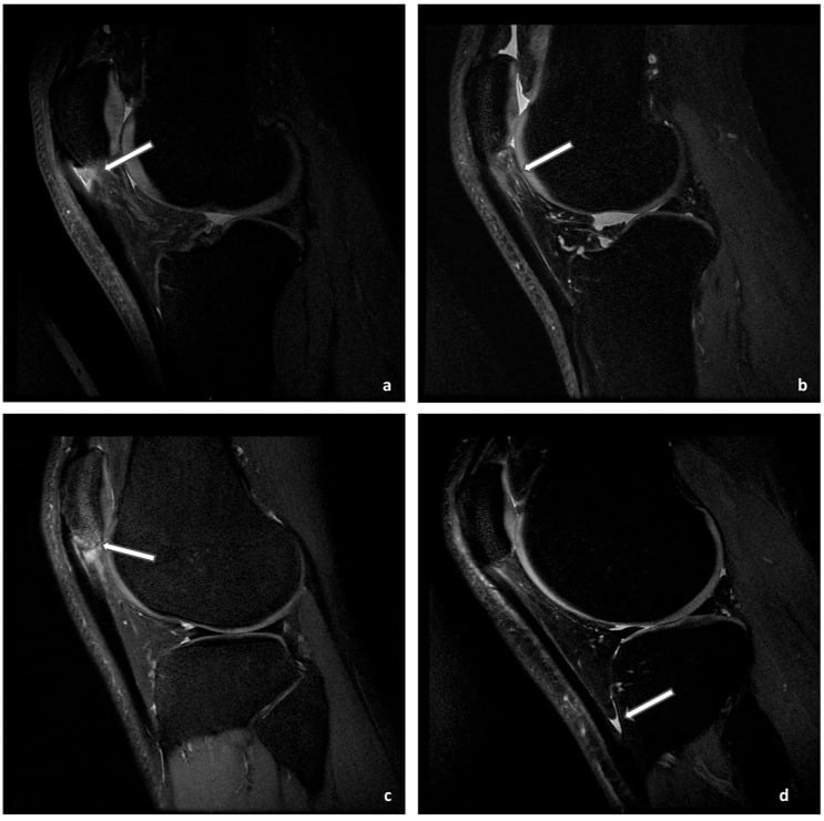 Sagittal fat-suppressed MRI showing tendon disruption, fat-pad oedema, marrow oedema and deep infrapatellar bursitis.