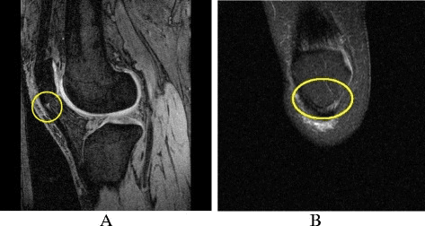Sagittal and coronal fat-saturated MRI showing proximal patellar tendinopathy.