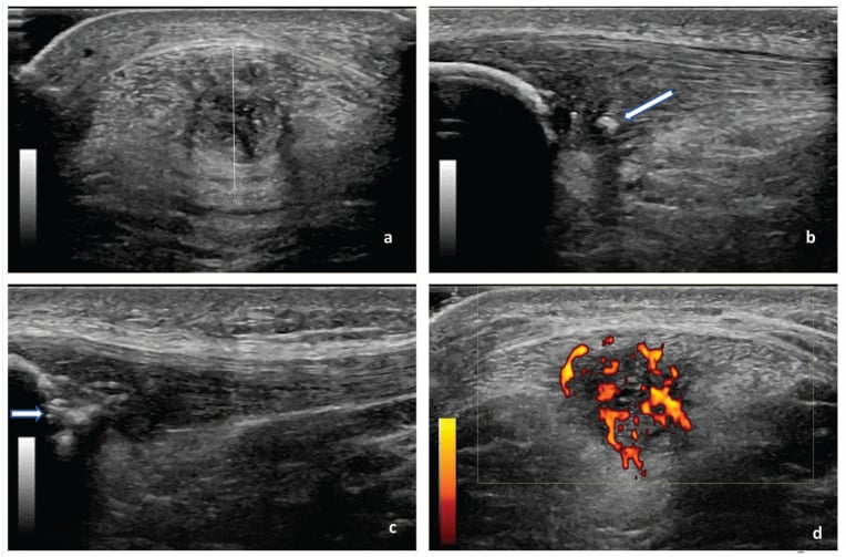Ultrasound panels showing patellar tendon thickness, calcification, patellar erosion and power-Doppler flow.