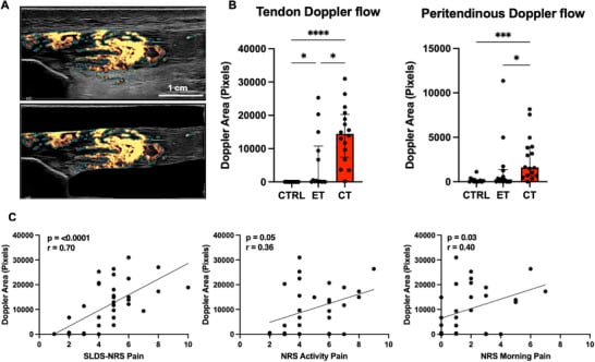 Power Doppler ultrasound and plots of tendon blood flow in healthy, early and chronic patellar tendinopathy.