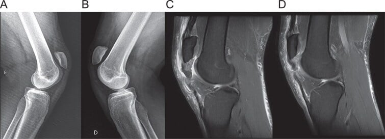 Bilateral lateral radiographs and sagittal MRI showing patella alta and proximal tendon rupture with tendinosis.