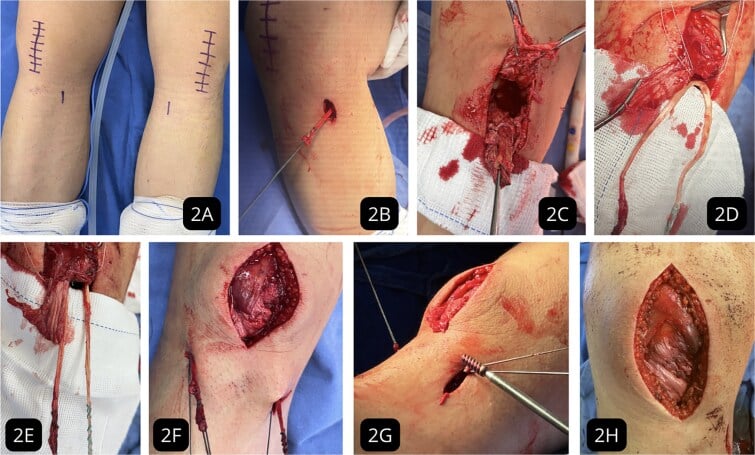 Operative sequence of gracilis-augmented repair of a ruptured degenerative patellar tendon.