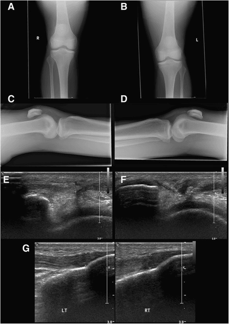 Bilateral patellar tendon rupture on AP and lateral radiographs and ultrasound showing tendon discontinuity in both knees.