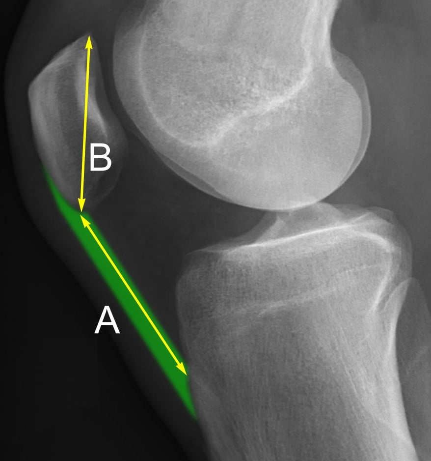 Lateral knee radiograph annotated with the Insall-Salvati ratio measurement: patellar tendon length A divided by patella length B