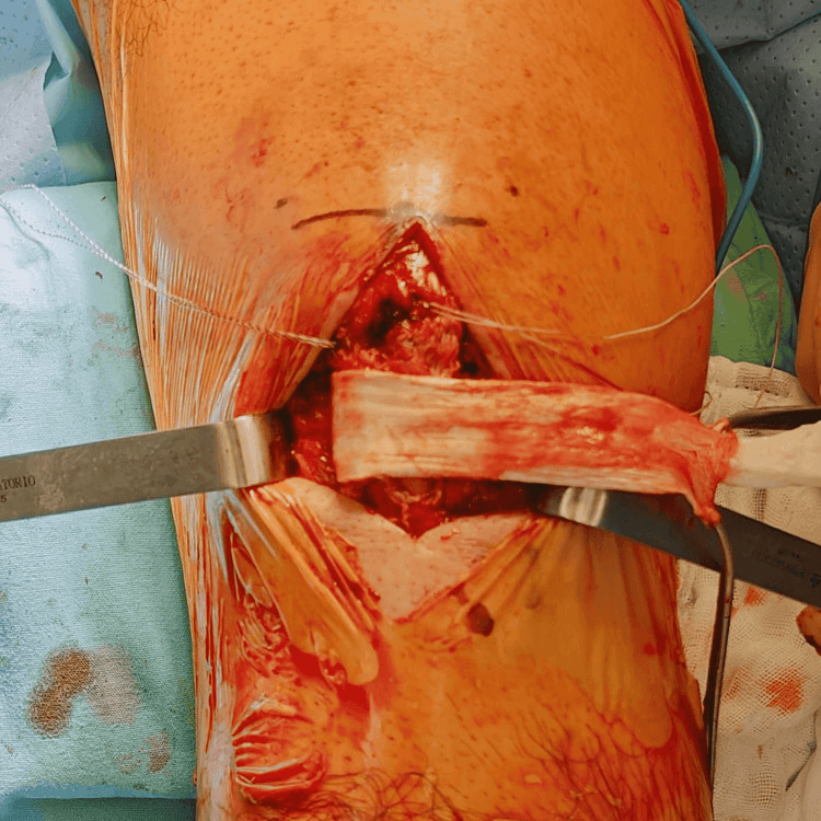 Intraoperative view of an Achilles tendon allograft strip passed across a patellar tendon repair site
