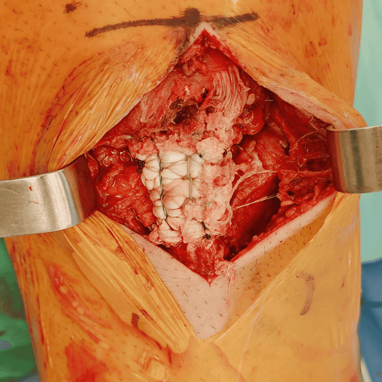 Intraoperative view showing Achilles allograft incorporated into the native patellar tendon repair