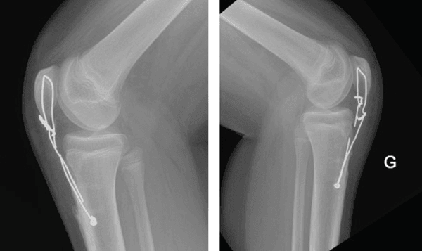 Bilateral postoperative lateral knee radiographs showing broken augmentation wires despite restored patellar height