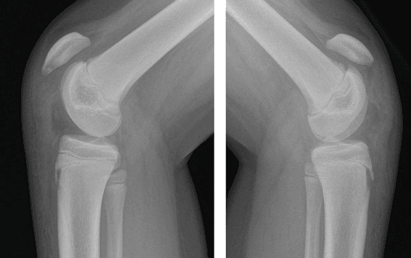 Bilateral lateral knee radiographs showing patella alta and swelling over the tibial tubercles