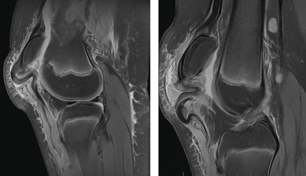 Bilateral sagittal knee MRI showing purely tendinous distal patellar tendon avulsions