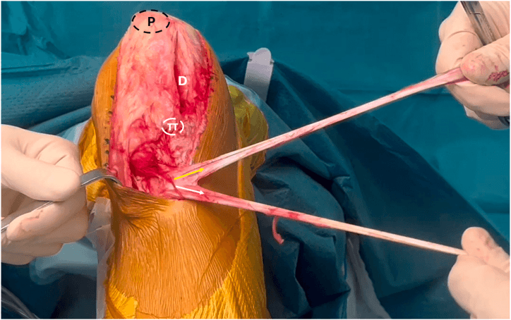 Intraoperative view of harvested semitendinosus and gracilis tendons remaining attached distally