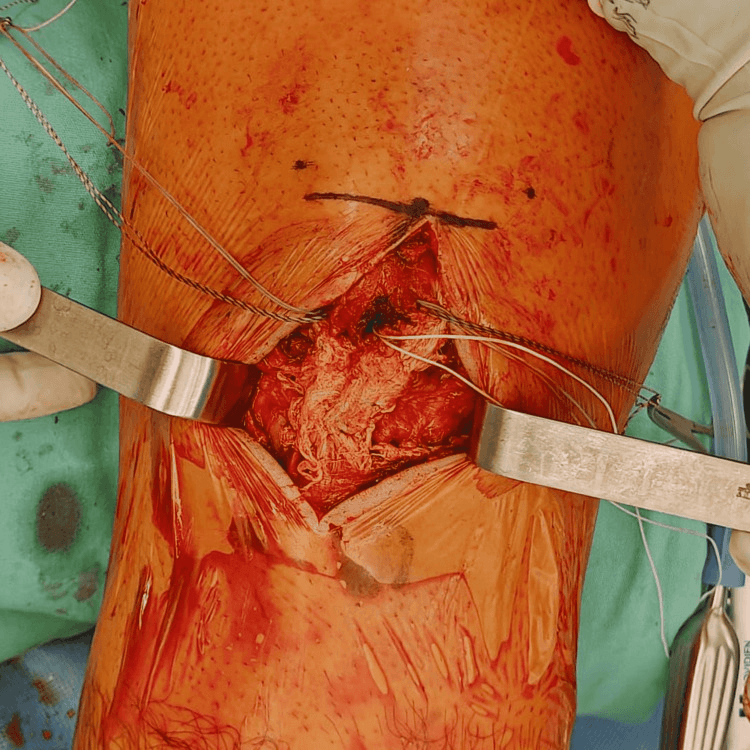 Intraoperative view showing suture limbs from anchors placed in the inferior pole of the patella