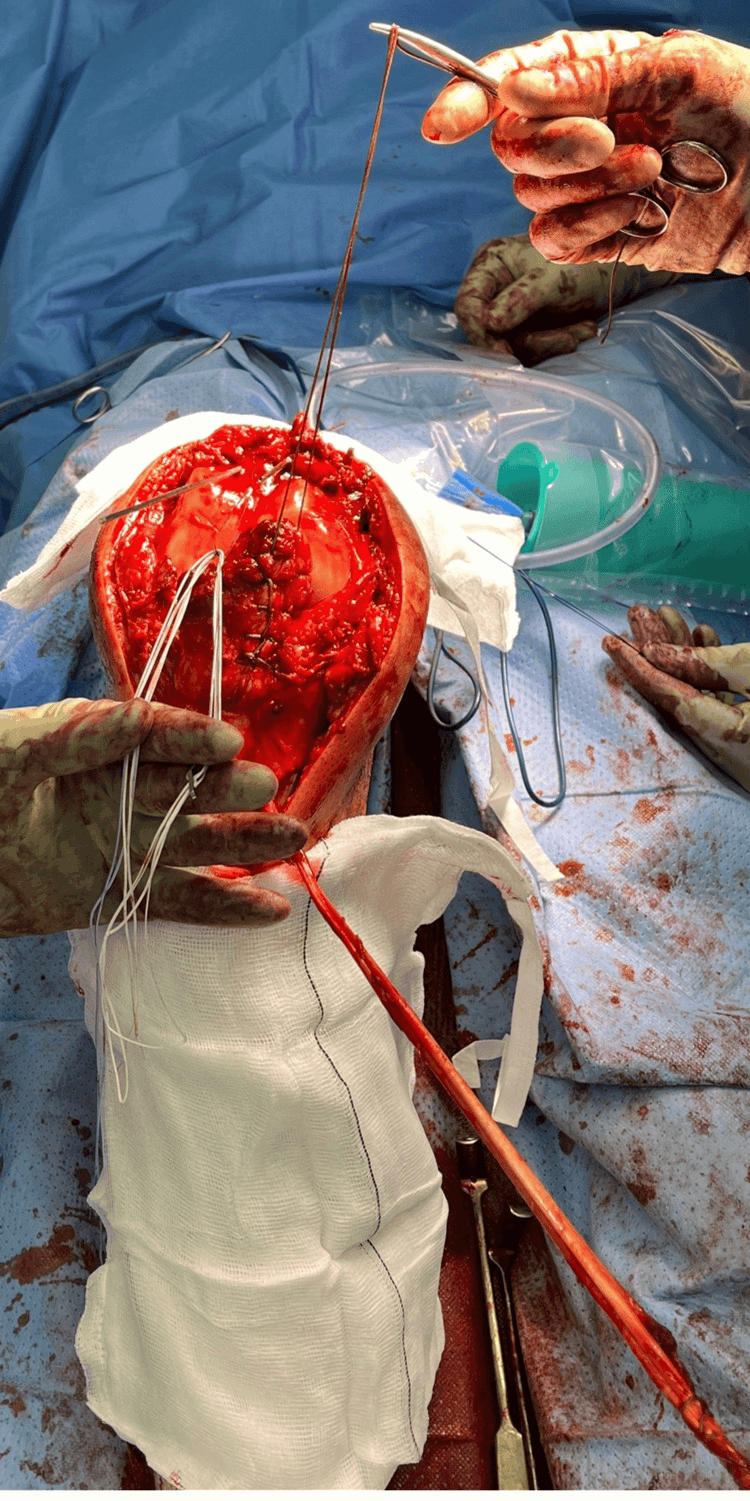 Intraoperative view showing sutures in the residual tendon and a hamstring graft prepared for patellar tendon reconstruction