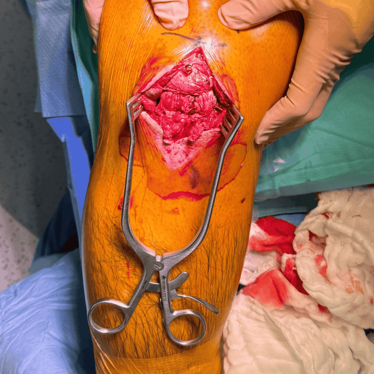 Intraoperative view of a complete midsubstance patellar tendon rupture with poor tissue quality