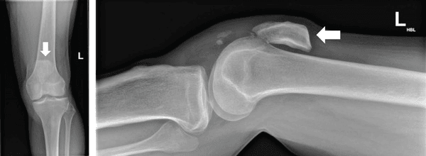 Anteroposterior and lateral knee radiographs showing superior displacement of the patella after patellar tendon rupture