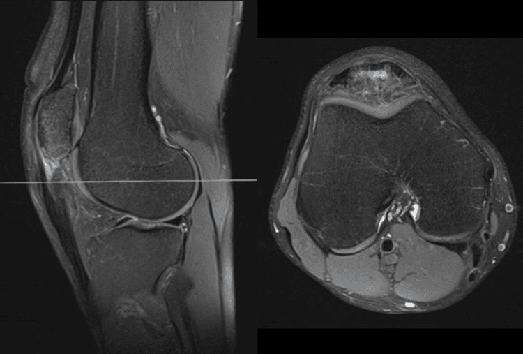 Sagittal and axial MRI showing an intact but thickened, high-signal tendinopathic proximal patellar tendon