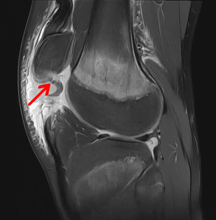 Sagittal knee MRI with an arrow at the inferior pole of the patella marking a proximal patellar tendon avulsion