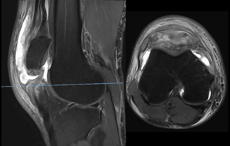 Sagittal and axial MRI showing recurrent discontinuity of the proximal patellar tendon