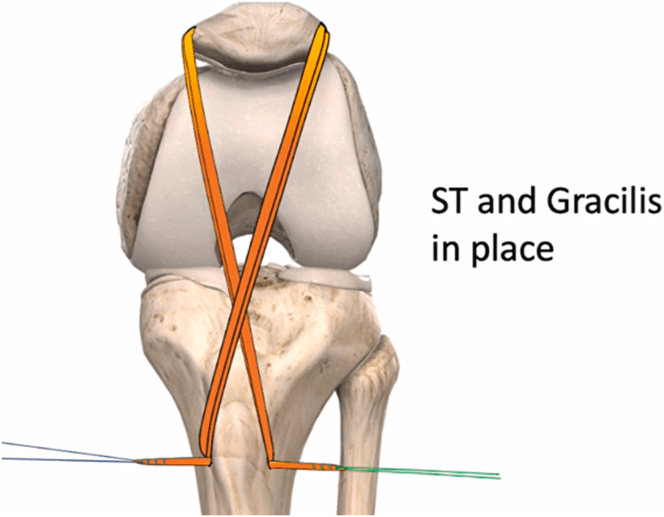 Diagram showing semitendinosus and gracilis grafts crossed through the patellar defect in a reverse figure-of-eight