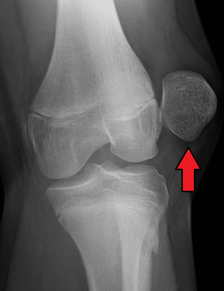 AP knee radiograph showing an acute lateral patellar dislocation with the patella displaced laterally