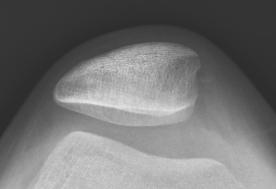 Skyline view of the knee showing lateral patellar tilt and subluxation over a shallow trochlea