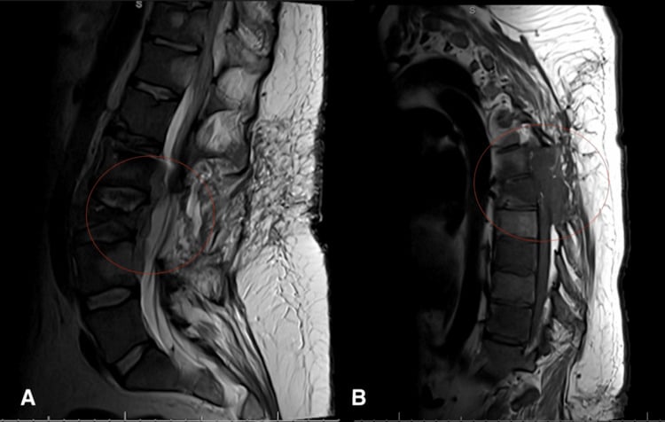 Sagittal T2 MRI demonstrating metastatic epidural disease and spinal cord compression