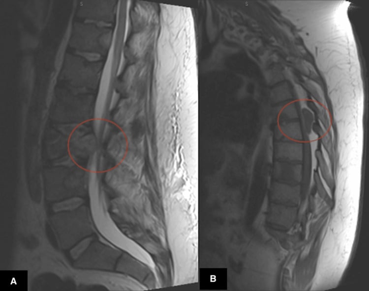 Sagittal T2 MRI demonstrating epidural metastatic disease and pathologic vertebral collapse