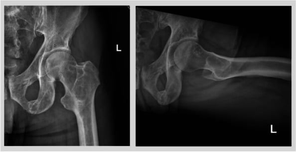 AP and lateral radiographs demonstrating an impending pathologic fracture through a lytic lesion