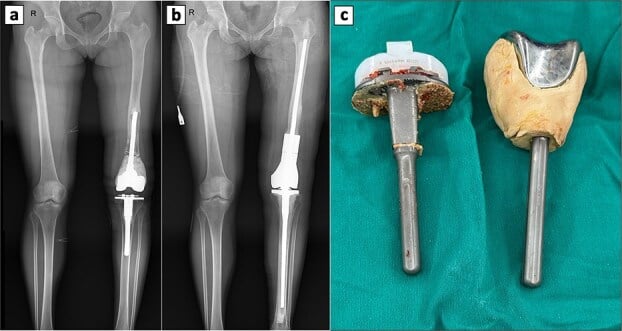 AP radiographs and components of distal femoral resection and megaprosthesis reconstruction