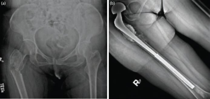AP pelvic and femur radiographs showing intertrochanteric pathologic fracture and cephalomedullary nailing