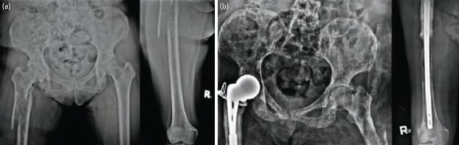AP radiographs showing subtrochanteric pathologic fracture and proximal femoral endoprosthesis