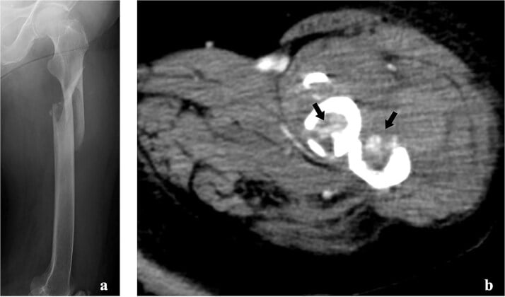 Radiograph (a) and axial CT (b) of a tumour-related femoral shaft fracture