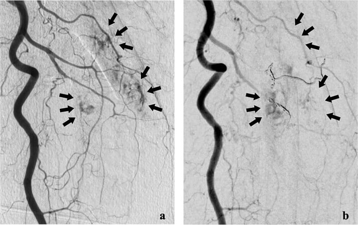 Femoral tumour angiography before and after embolisation