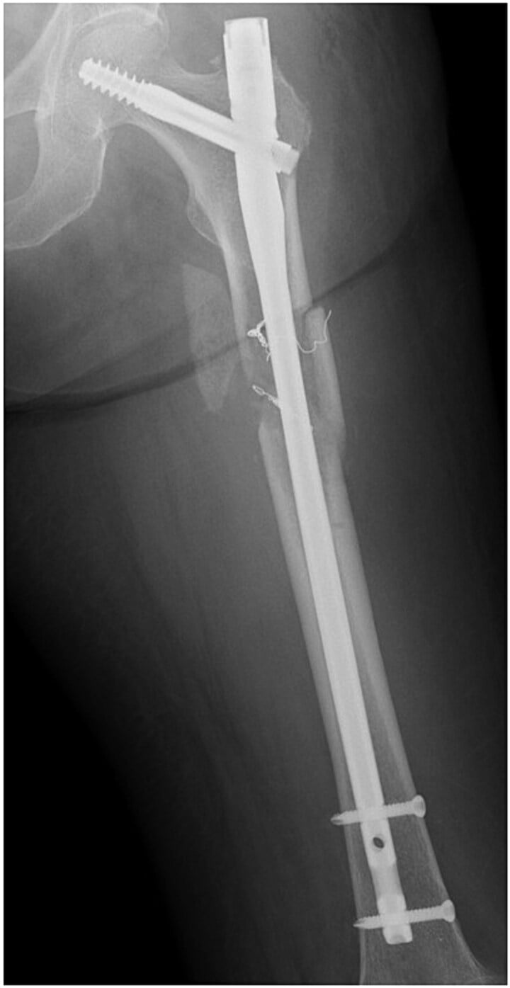 Long cephalomedullary nail with cerclage wires after pathological femoral shaft fracture